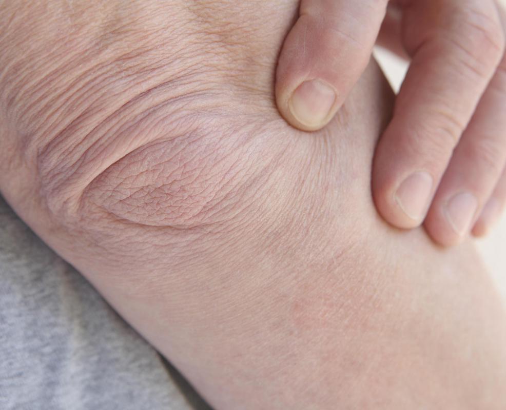 Tendinitis can cause left arm weakness.